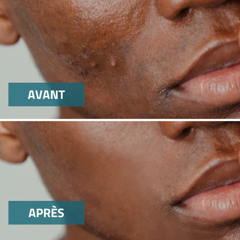 MINI SERUM D'ACIDE SALICYLIQUE